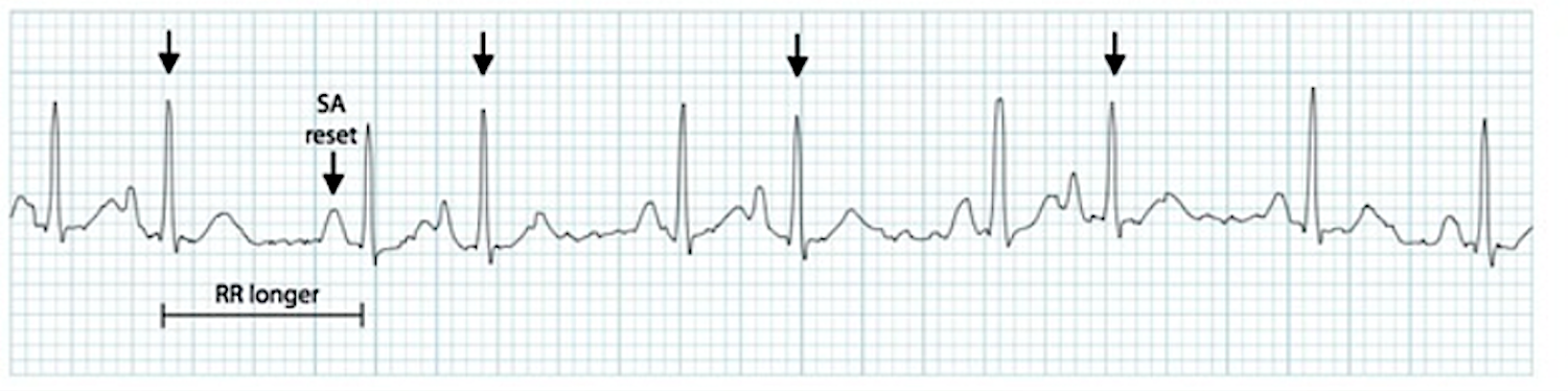 Interpreting an ECG Strip